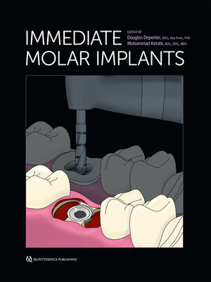cover image of Immediate Molar Implants